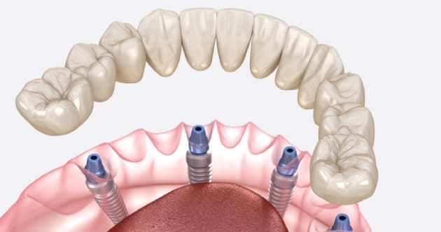 Зубнал Все на 4 имплантация
